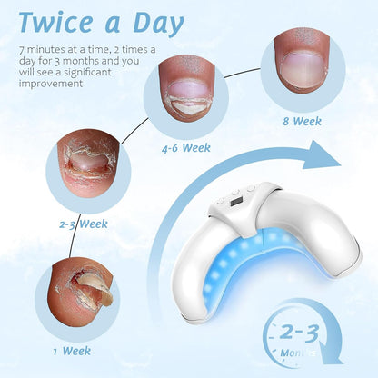 Anti-Fungal Laser Therapy Device